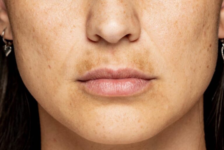 Hamilelikte Cilt Lekeleri Nasıl Oluşur?